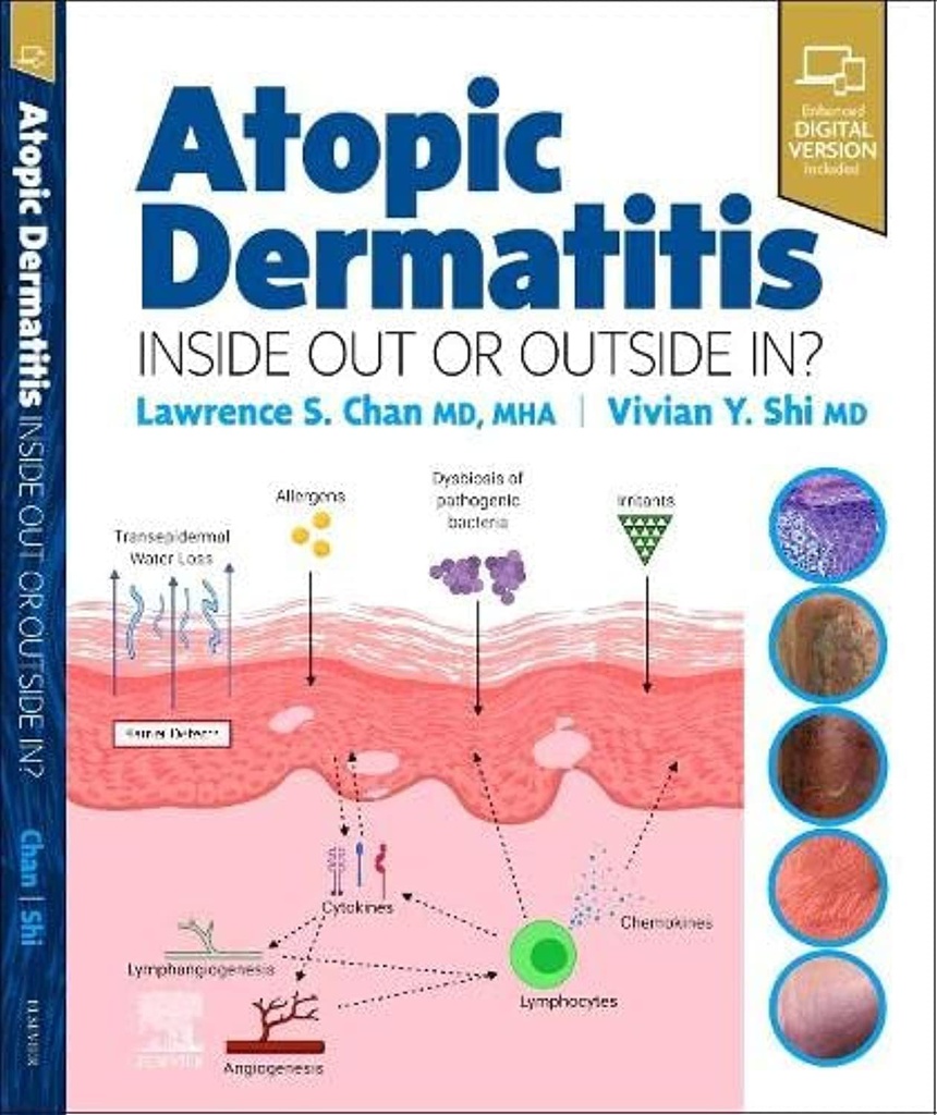 Atopic Dermatitis: Inside Out or Outside In: 1ed