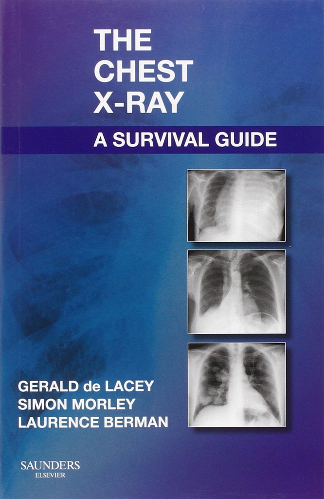 The Chest X-Ray: A Survival Guide: 1ed