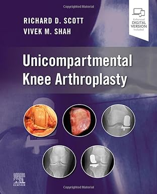 Unicompartmental Knee Arthroplasty: 1ed