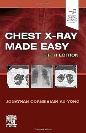 Chest X-Ray Made Easy: 5ed