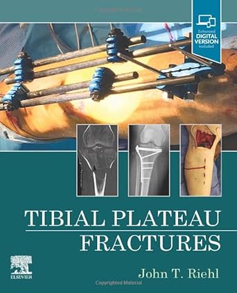 Tibial Plateau Fractures: 1ed