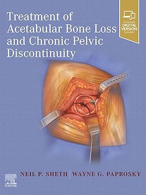 Treatment of Acetabular Bone Loss and Chronic Pelvic Discontinuity: 1ed