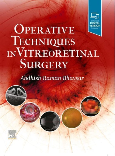 [B9780323709200] Operative Techniques in Vitreoretinal Surgery: 1ed